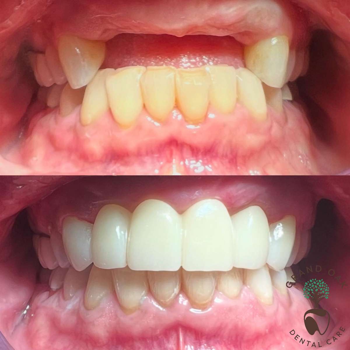 Cosmetic Teeth Replacement Bridge